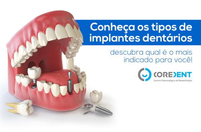 Conheça Os Tipos De Implantes Dentários E Descubra Qual é O Mais 9718